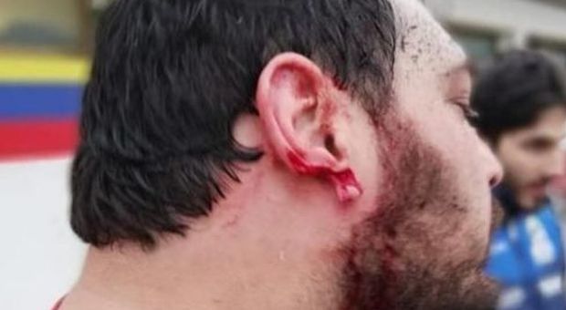 Orecchio staccato con un morso durante una mischia al match di rugby: 25enne condannato