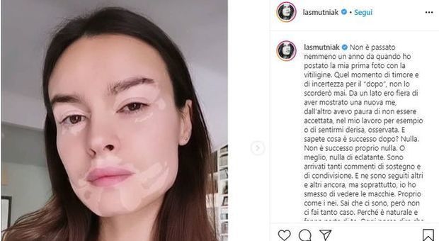 Kasia Smutniak lancia il filtro Instagram con la vitiligine: «Ecco la bellezza della diversità»