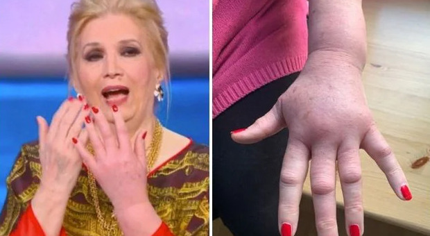 Iva Zanicchi e la mano gonfia, la reazione allergica dopo la puntura di una vespa: come sta oggi