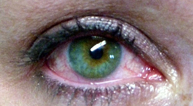 Sindrome dell'occhio secco: ne soffre il 60% delle donne dopo i 50 anni