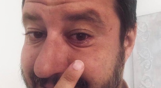 Salvini ha l'orzaiolo: «Lo curo con i rimedi della nonnina». Burioni: «In realtà guarisce spontaneamente»