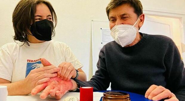 Dieci mesi fa la grande paura: Gianni Morandi mostra per la prima volta la gravità dell ustione subita alla mano