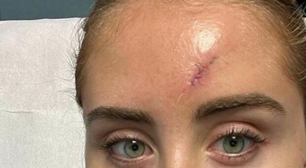 Intervento chirurgico fatto: Valentina Ferragni mostra la cicatrice sulla fronte dopo l operazione