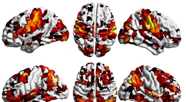 Trovata nel cervello la "culla" della schizofrenia: da scienziati italiani la svolta nella ricerca