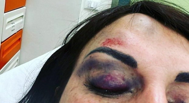 Francesca De Andrè ha pubblicato per la prima volta una foto delle violenze subito dall'ex compagno