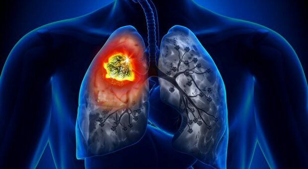 Tumore al polmone non a piccole cellule: via libera in Italia a una terapia mirata, ok dell'Aifa
