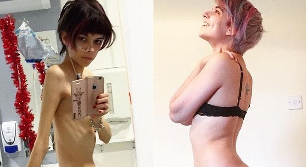 Guarisce dall'anoressia e mostra il suo percorso su Instagram: "Volevo morire"