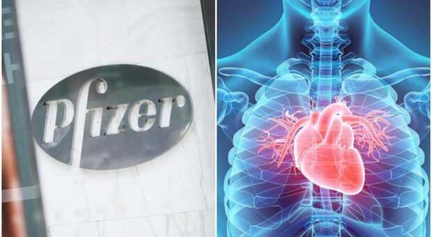 Effetti collaterali Pfizer, cos'è la miocardite e quando si può verificare: quali sintomi tenere sott'occhio
