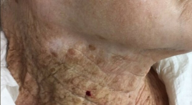 Mette la crema solare sul viso (ma non sul collo) per 40 anni: ecco gli effetti sulla pelle di una donna anziana