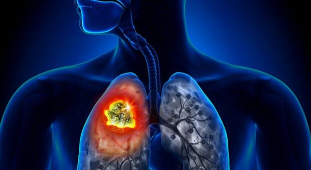 Tumore polmone, l'inquinamento può causarlo anche nei non fumatori: svelato il meccanismo